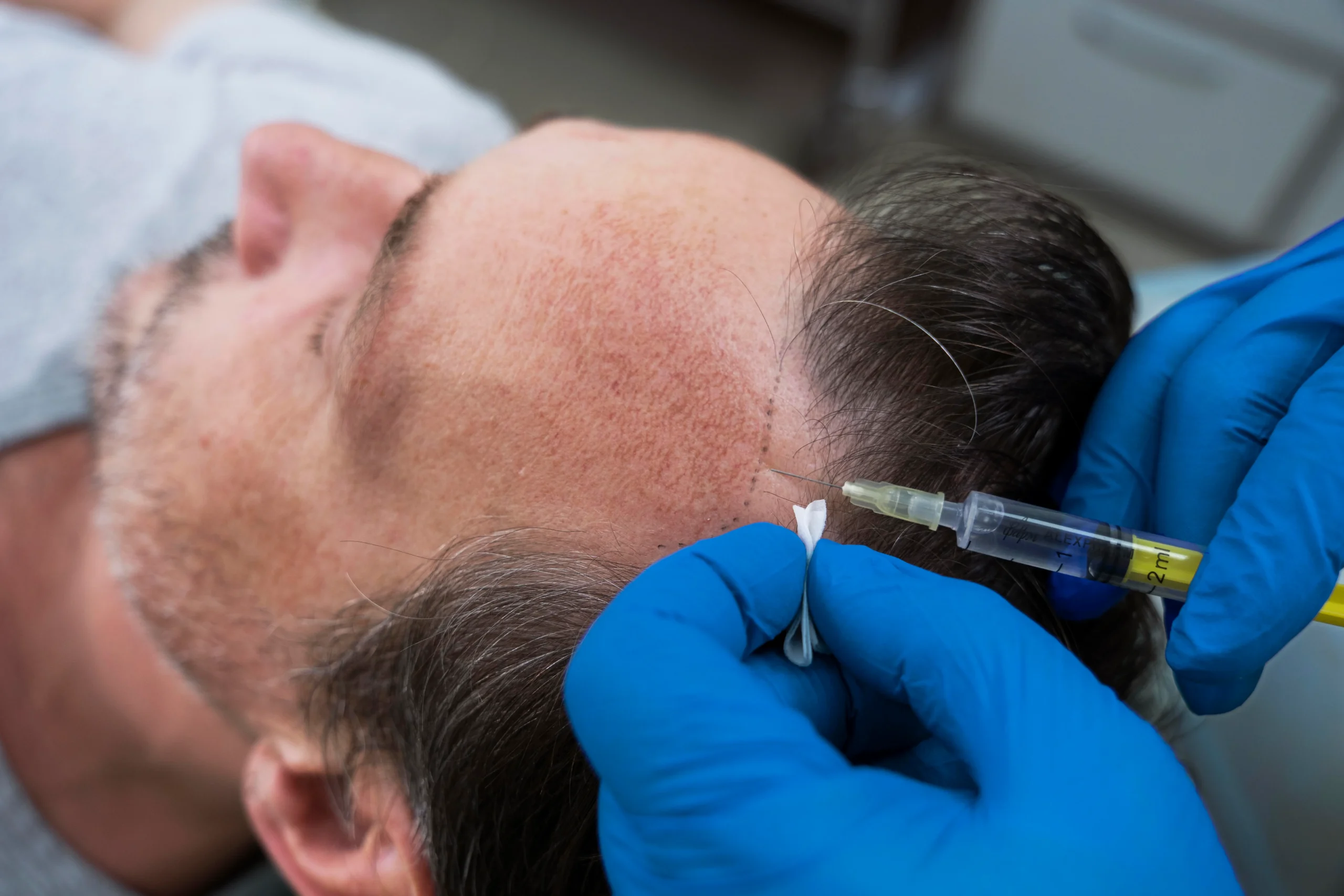 PRP Treatment for Hair Loss